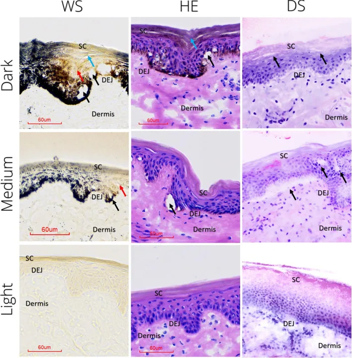 Laser de picossegundos com lente fracionada — histologia de pele escura, média e clara com vacúolos — Dr. Thiago Perfeito