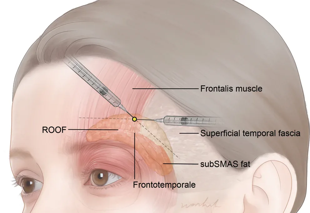 Desenho da fronte e da têmpora com o ponto de entrada único da cânula junto ao frontotemporal — figura de estudo — Dr. Thiago Perfeito