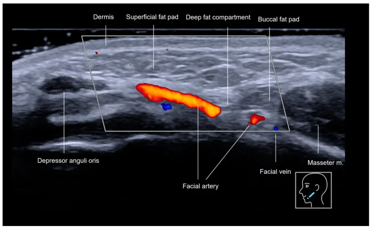 Doppler da região anterior da mandíbula com artéria facial, veia facial e masseter — figura de estudo — Dr. Thiago Perfeito