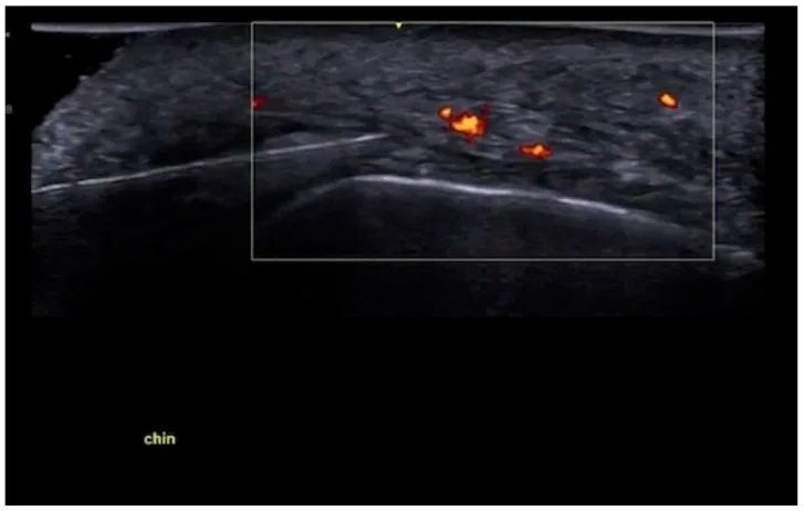 Ultrassom com Doppler de cânula no plano profundo do queixo — figura de estudo — Dr. Thiago Perfeito