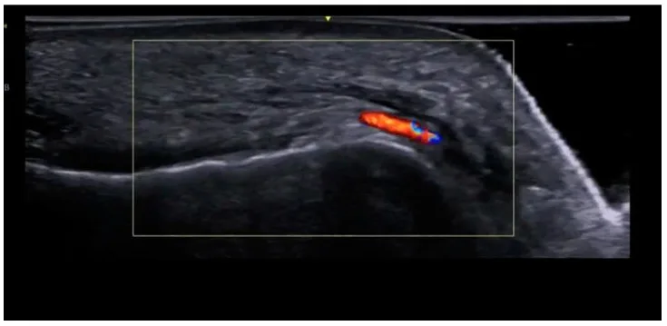 Doppler colorido do queixo em corte sagital com artéria submentual sob o músculo mentual — figura de estudo — Dr. Thiago Perfeito