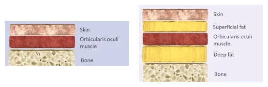 Esquema das camadas do sulco lacrimal medial e do sulco palpebromalar lateral — figura de estudo — Dr. Thiago Perfeito