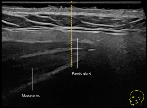 Ultrassom do ângulo da mandíbula com parótida, masseter e linha de medida da profundidade do músculo — figura de estudo — Dr. Thiago Perfeito