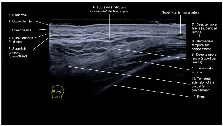 Ultrassom da têmpora em corte transversal mostrando as camadas até o osso — figura de estudo — Dr. Thiago Perfeito