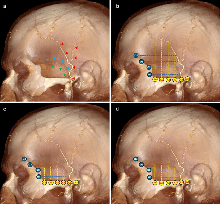Angiotomografia em perfil do crânio com artéria temporal superficial, artéria zigomático-orbital e veia temporal média marcadas — figura de estudo — Dr. Thiago Perfeito