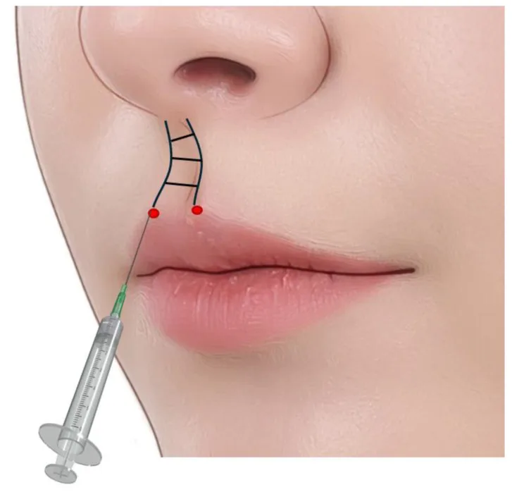 Técnica de injeção nas colunas do filtro a partir dos picos do arco do cupido — figura de estudo — Dr. Thiago Perfeito