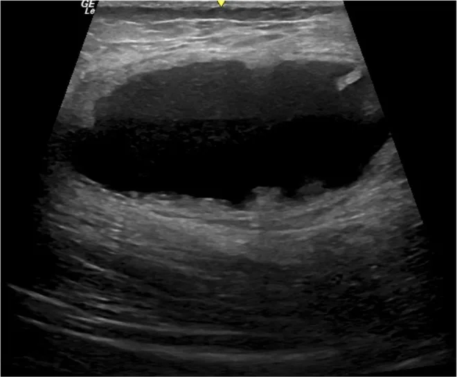 Ultrassom de coleção com necrose central após enxerto de gordura no glúteo — Dr. Thiago Perfeito