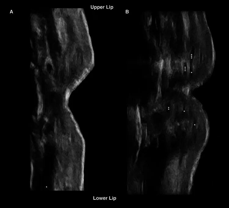 Ultrassom dos lábios finos antes e depois do preenchimento com cânula — figura de estudo — Dr. Thiago Perfeito