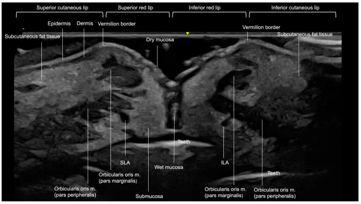 Ultrassom longitudinal dos lábios com camadas, orbicular e artérias labiais — figura de estudo — Dr. Thiago Perfeito