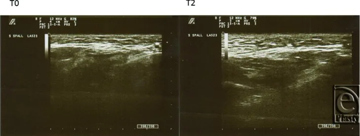 Ultrassom da região submalar antes e três meses depois do bioremodelador de ácido hialurônico — Dr. Thiago Perfeito