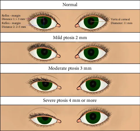 Desenho da classificação da ptose palpebral em leve, moderada e grave pela altura da margem — Dr. Thiago Perfeito