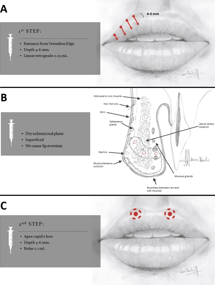 Esquema da técnica com agulha no lábio superior com pontos de entrada, plano submucoso seco e bolus no arco do cupido — figura de estudo — Dr. Thiago Perfeito