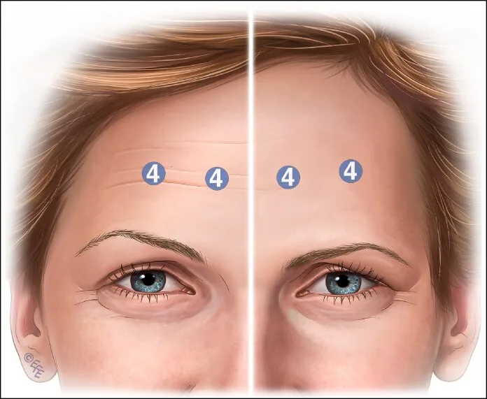 Queda da sobrancelha após toxina no frontal — pontos de injeção e posição da sobrancelha — Dr. Thiago Perfeito