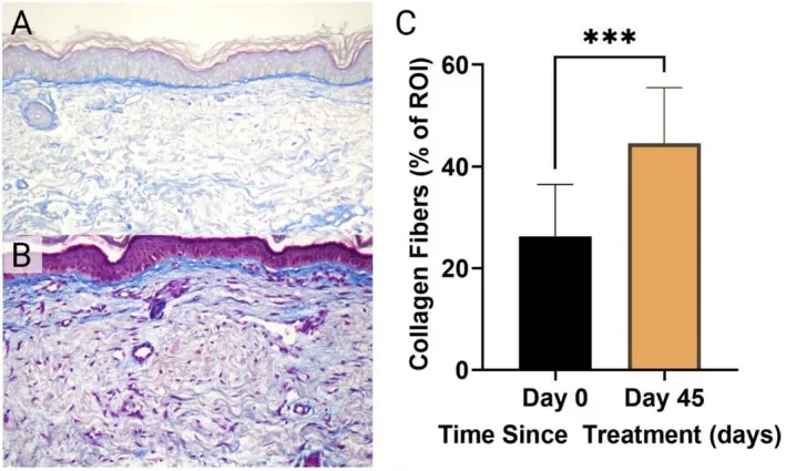 Histologia com tricrômico de Masson da pele do antebraço antes e depois de Radiesse hiperdiluído, com gráfico de colágeno — Dr. Thiago Perfeito