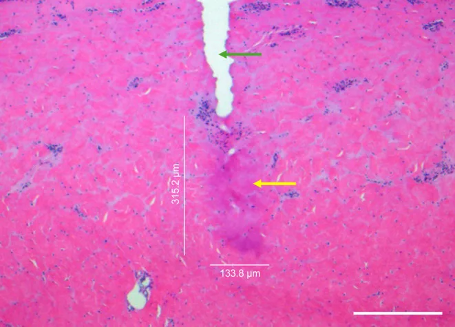 Histologia de pele logo após radiofrequência microagulhada mostrando o trajeto da agulha e a zona de coagulação na derme — Dr. Thiago Perfeito