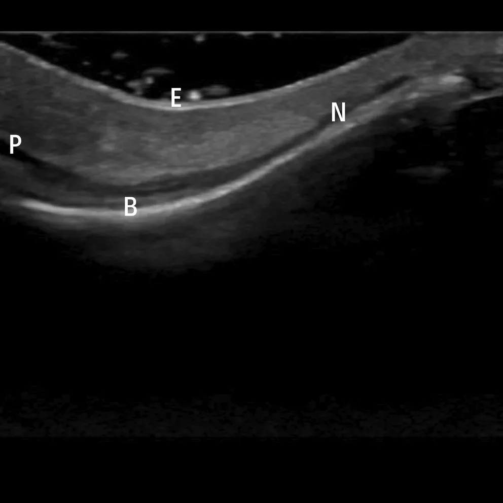 Ultrassom da raiz nasal mostrando epiderme, músculos prócero e nasal e osso nasal — figura de estudo — Dr. Thiago Perfeito