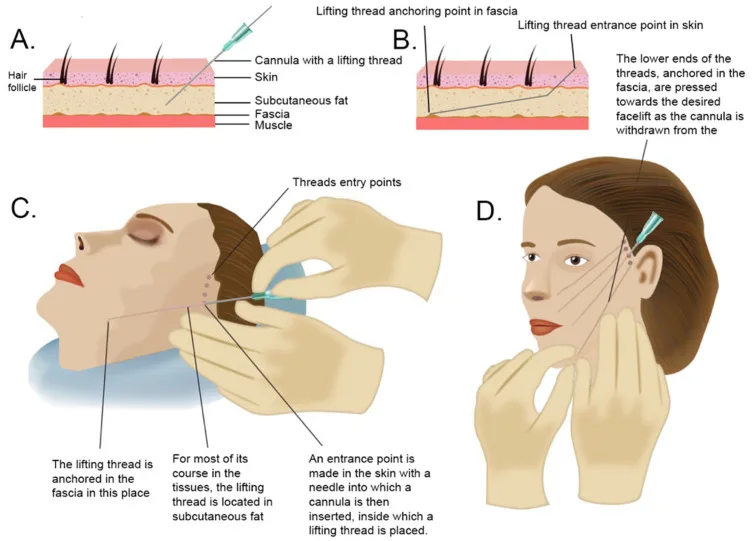 Esquema do fio de sustentação inserido por cânula na gordura subcutânea e ancorado na fáscia — Dr. Thiago Perfeito