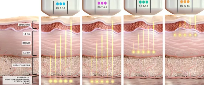 Transdutores de ultrassom microfocado com visualização e suas profundidades na pele — estudo de Vachiramon — Dr. Thiago Perfeito