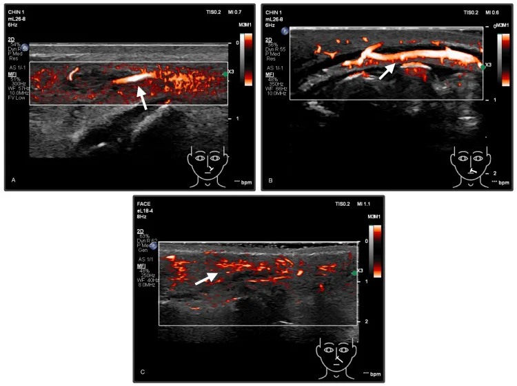 Ultrassom com Doppler e microfluxo depois da hialuronidase mostrando fluxo restaurado na artéria angular e na artéria labial superior — Dr. Thiago Perfeito