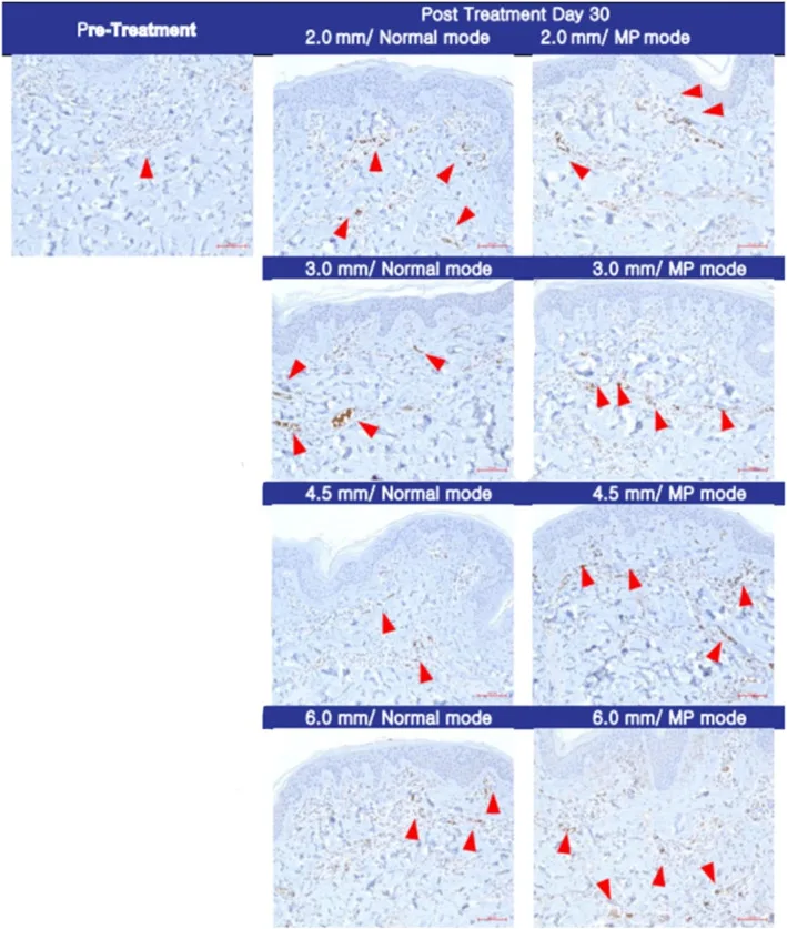 Imuno-histoquímica de colágeno 30 dias após ultrassom microfocado em quatro profundidades e dois modos — estudo de Hwang — Dr. Thiago Perfeito