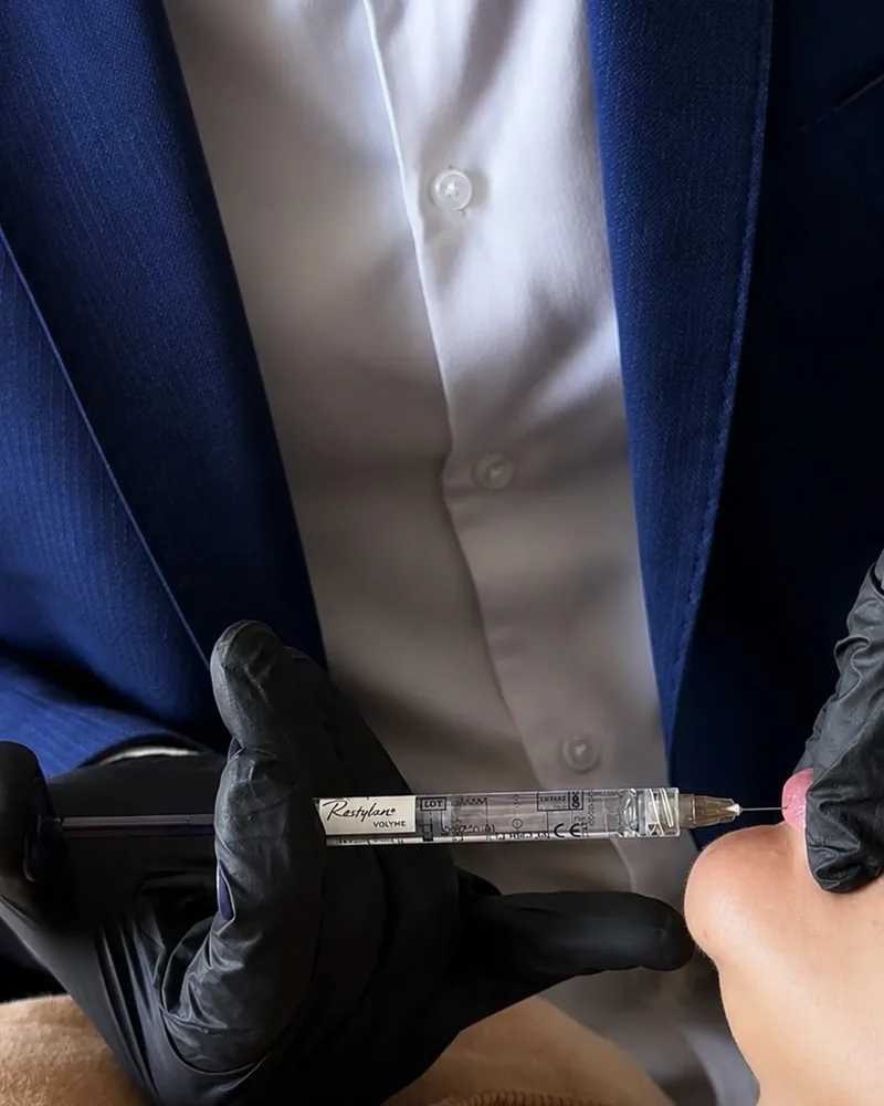 Preenchimento labial com agulha em paciente modelo, um dos hands-on do módulo A1