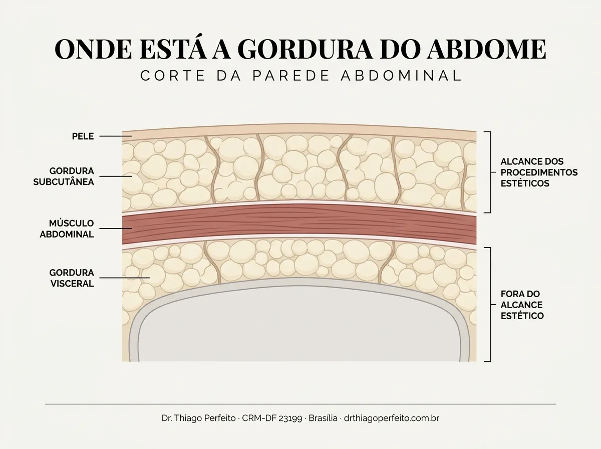 Diagrama em corte da parede abdominal: pele, gordura subcutânea, músculo abdominal e gordura visceral — Dr. Thiago Perfeito, Brasília