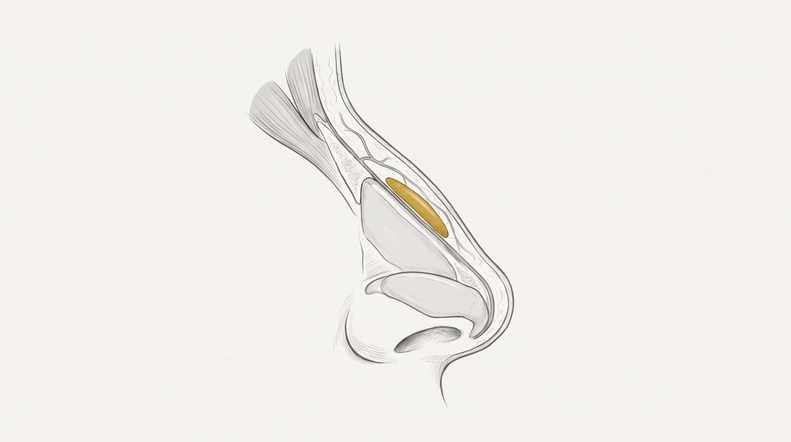 Rinomodelação — corte sagital do dorso nasal com gel no plano profundo da linha média — Dr. Thiago Perfeito