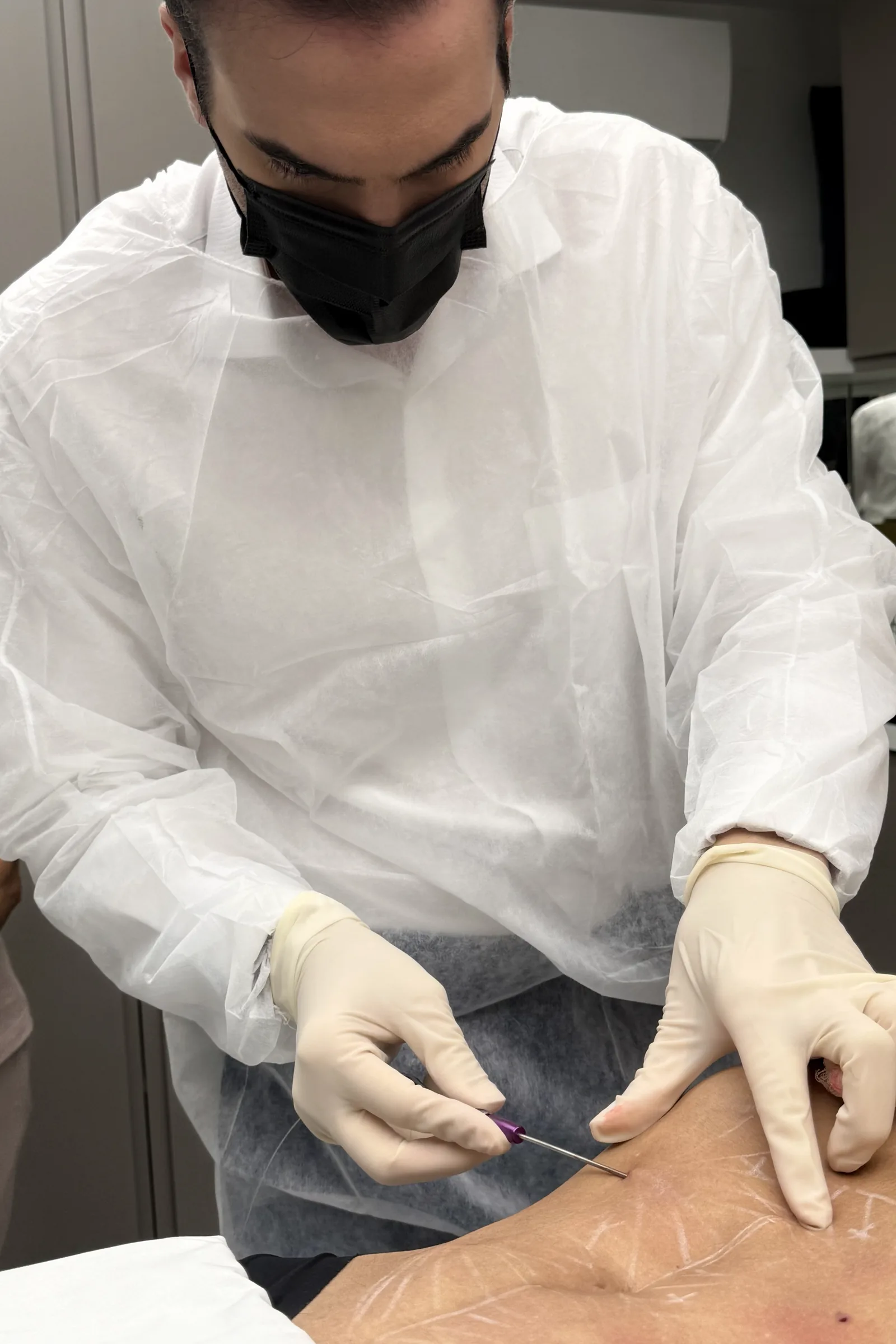 Dr. Thiago Perfeito realizando endolaser em Brasília