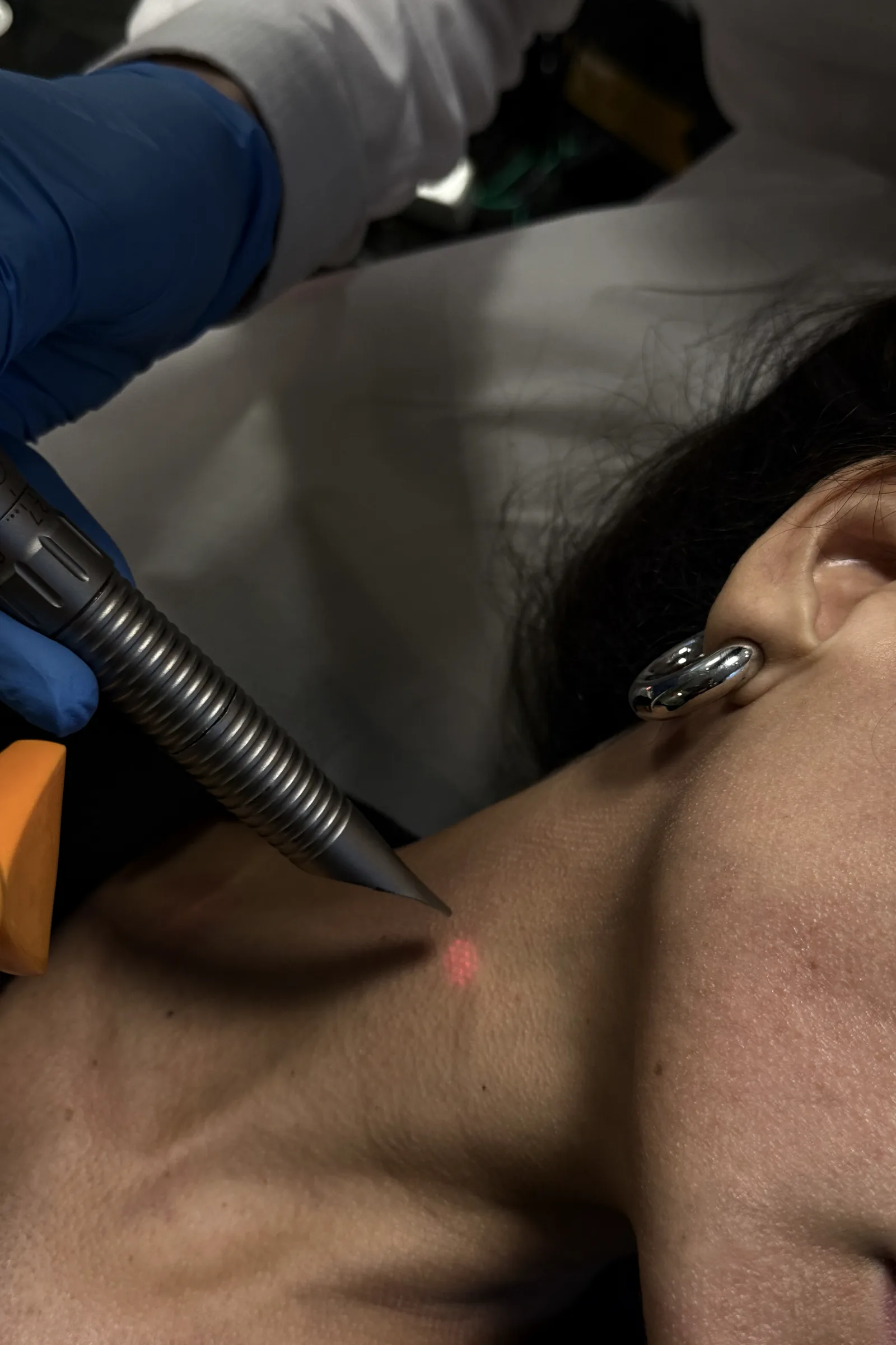Dr. Thiago Perfeito realizando laser Fotona em Brasília