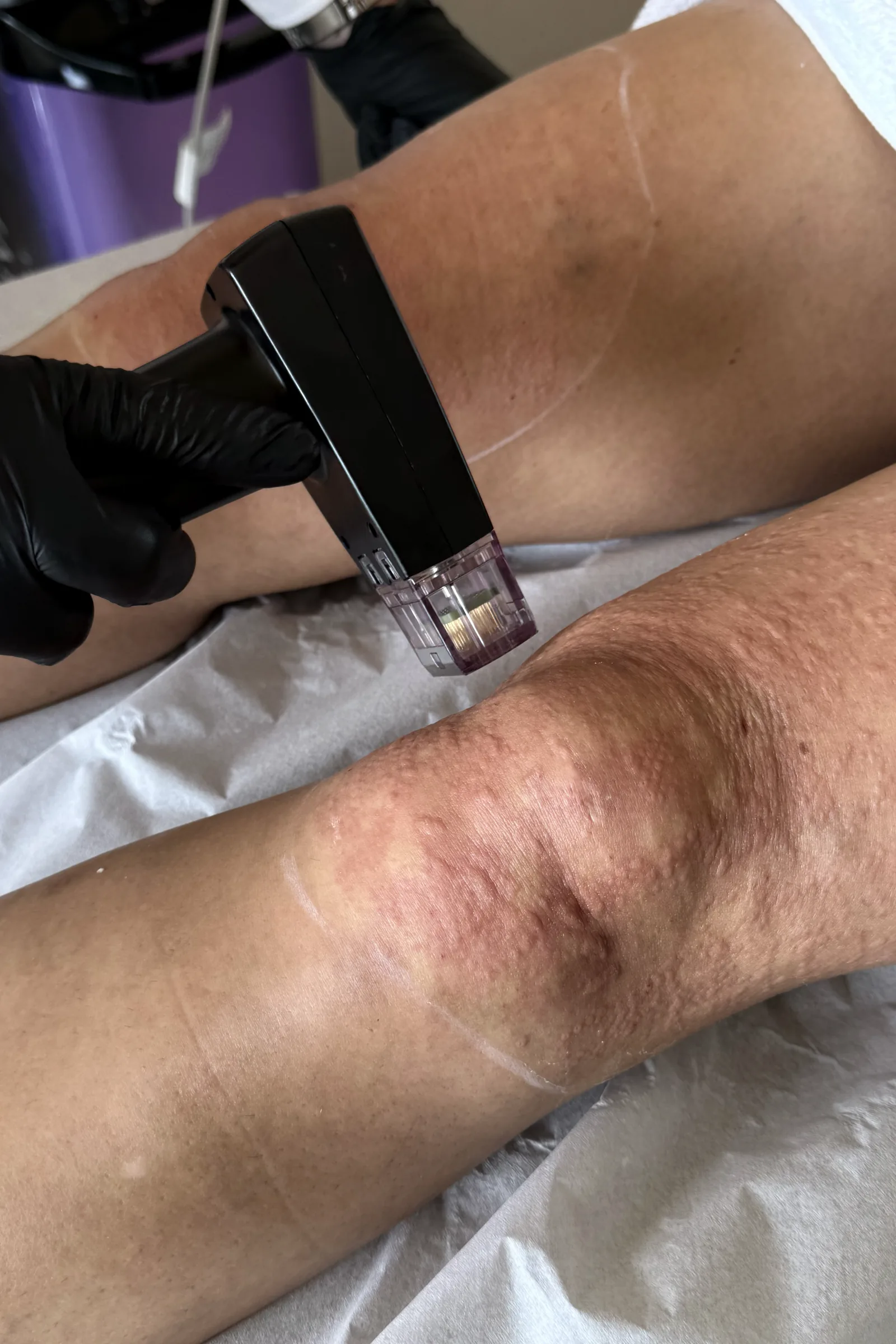Aplicação de Morpheus8 no joelho, em Brasília