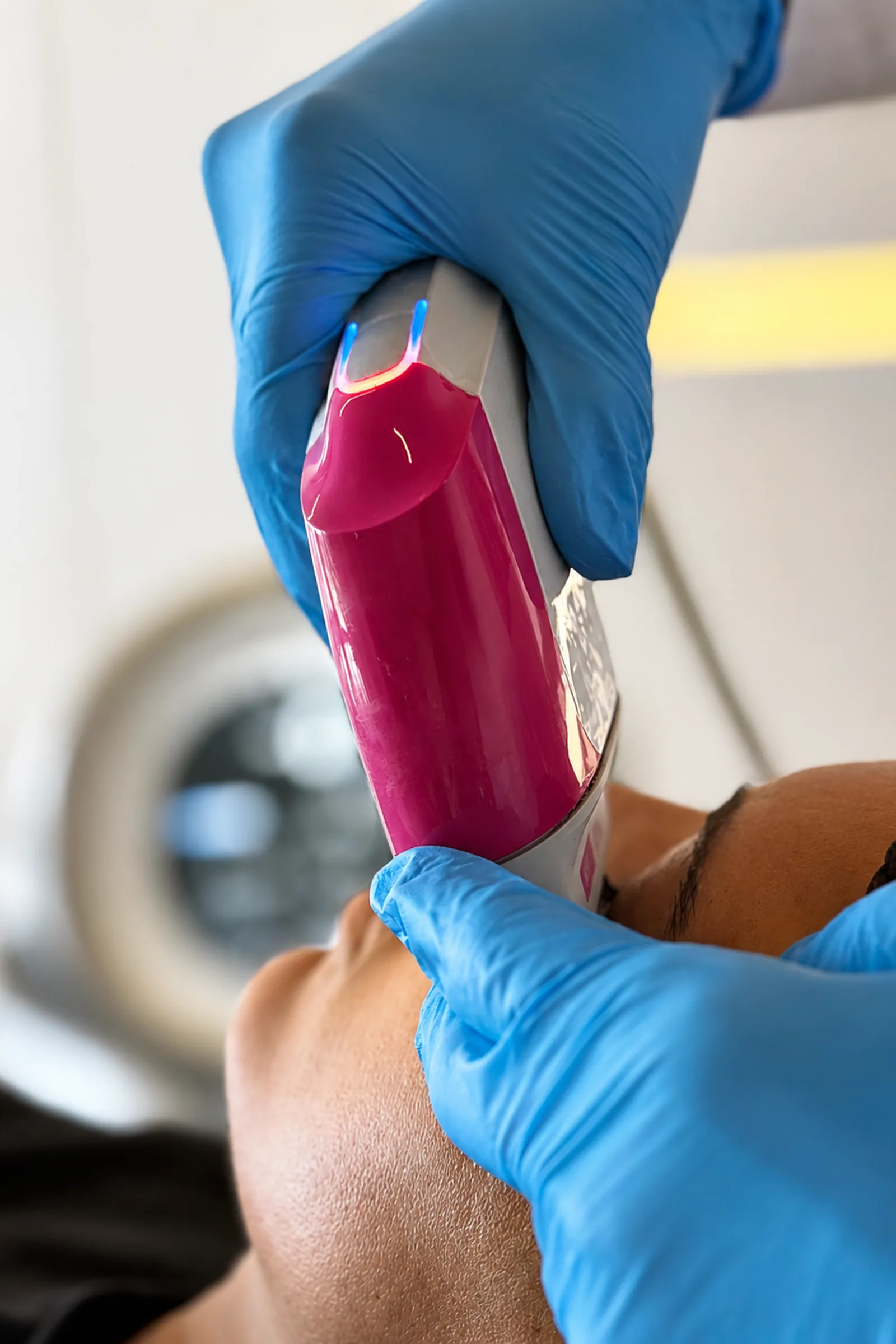 Dr. Thiago Perfeito realizando Ultraformer MPT em Brasília