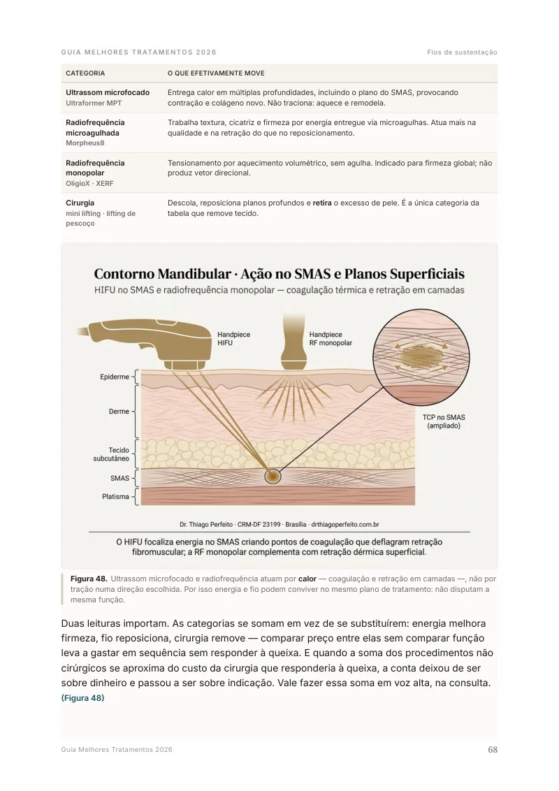 Ilustração anatômica do contorno mandibular com ultrassom microfocado no Guia Melhores Tratamentos 2026