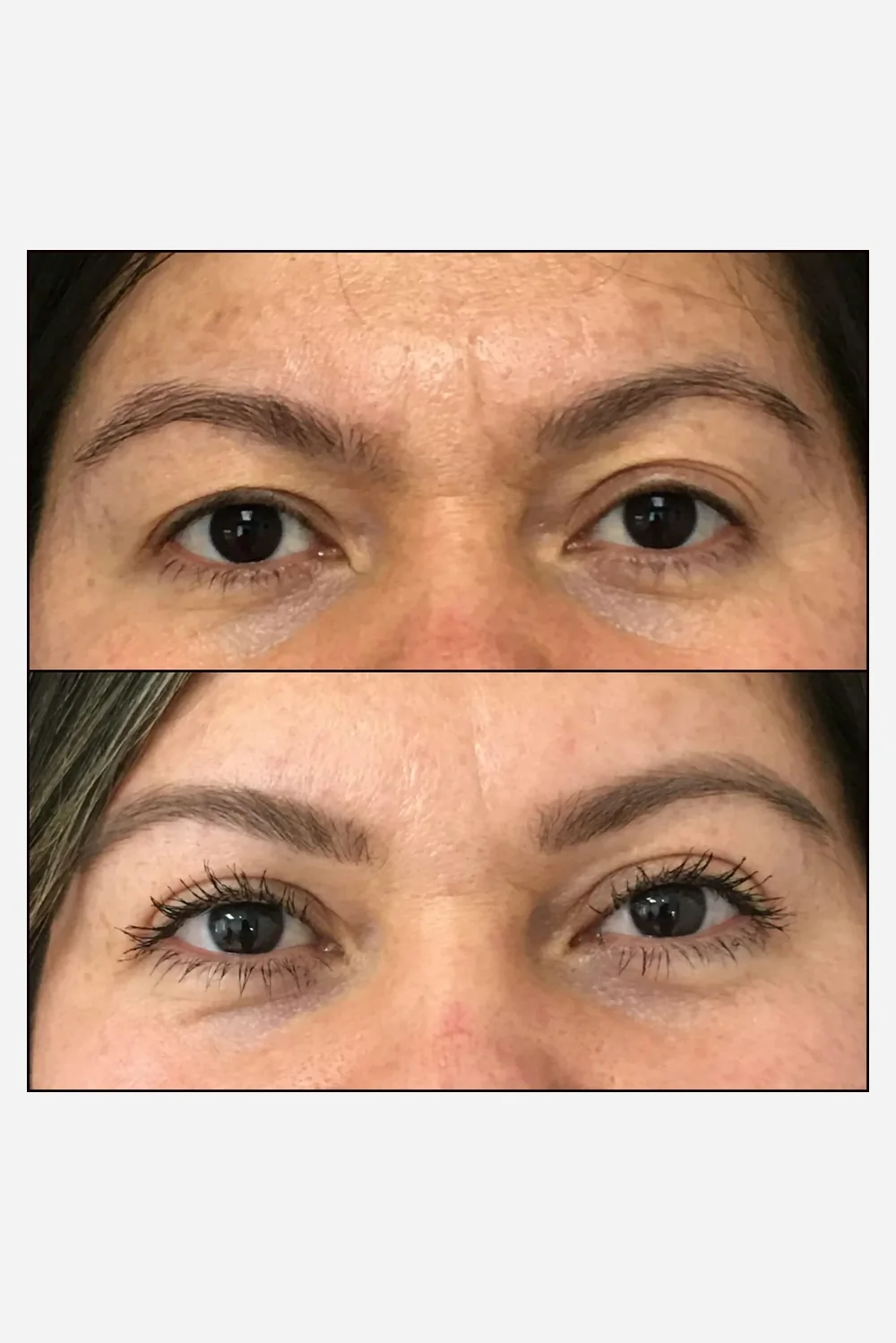 Antes e depois de cirurgia de pálpebras em Brasília