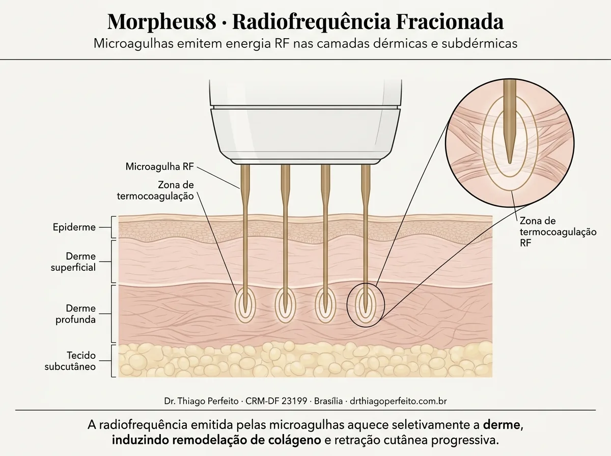 Diagrama anatômico — Contorno Corporal Morpheus8