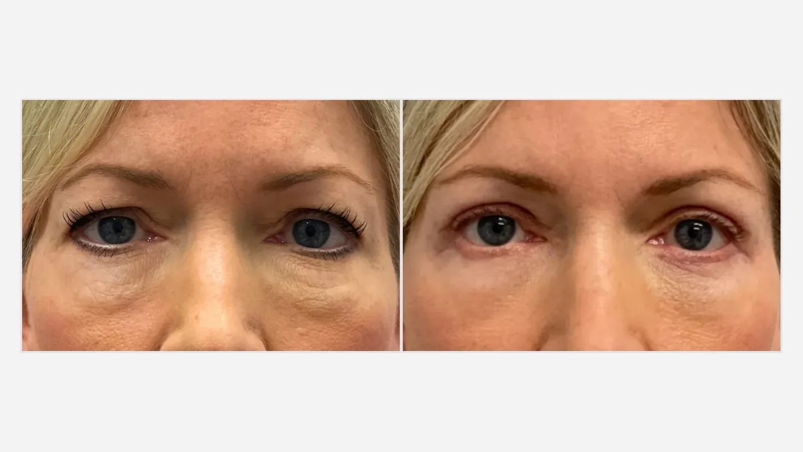 Antes e depois de blefaroplastia inferior em Brasília