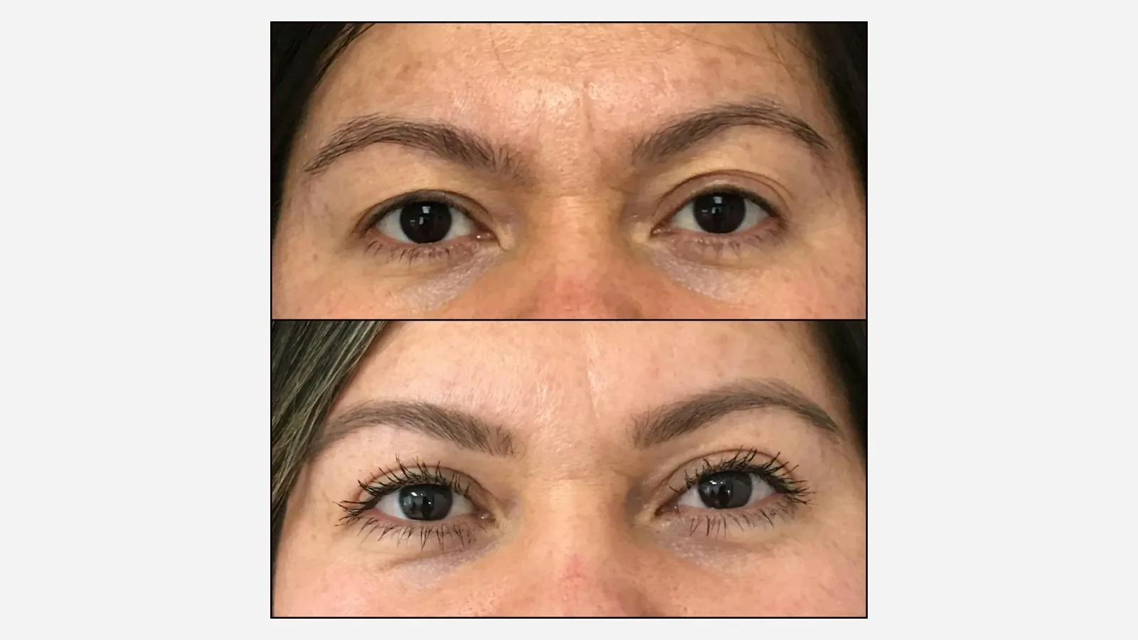 Antes e depois de blefaroplastia em Brasília
