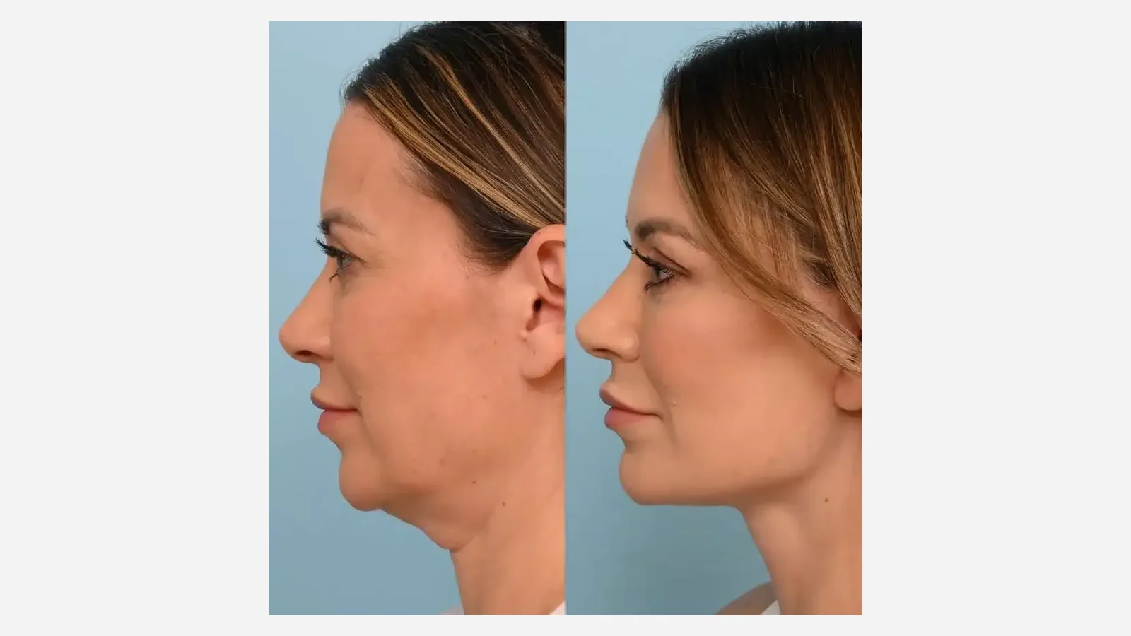 Antes e depois de cirurgia de pescoço em Brasília