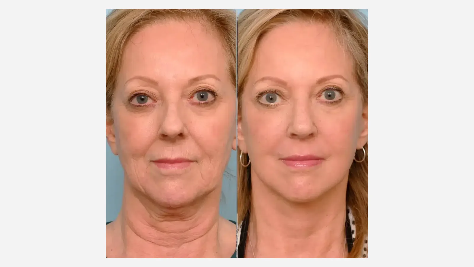 Antes e depois de lifting facial em Brasília