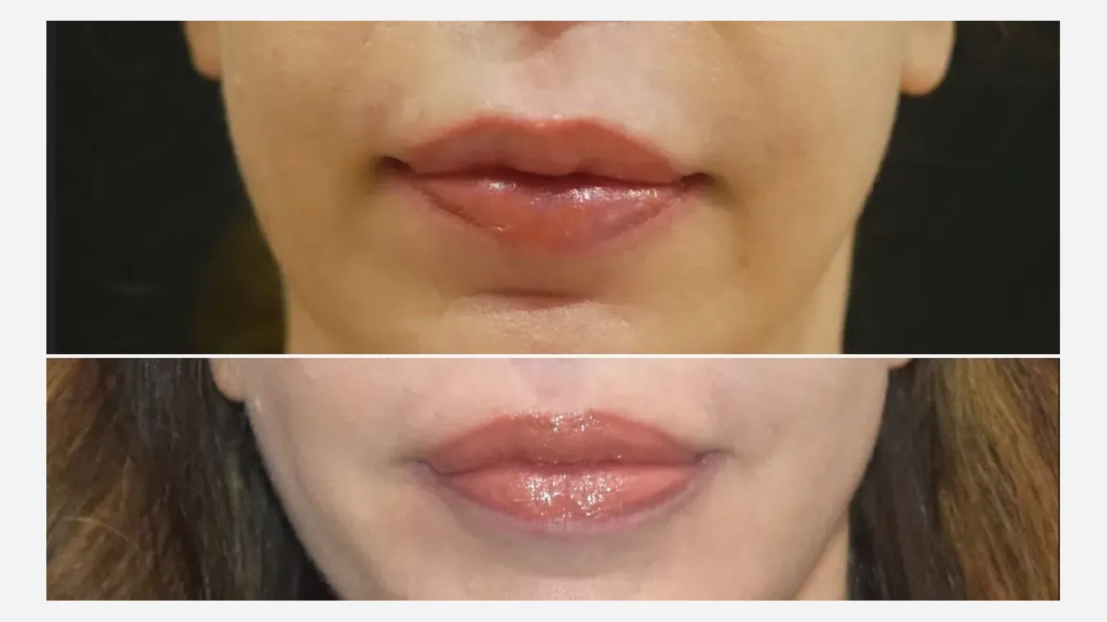 Antes e depois de lip lift em Brasília