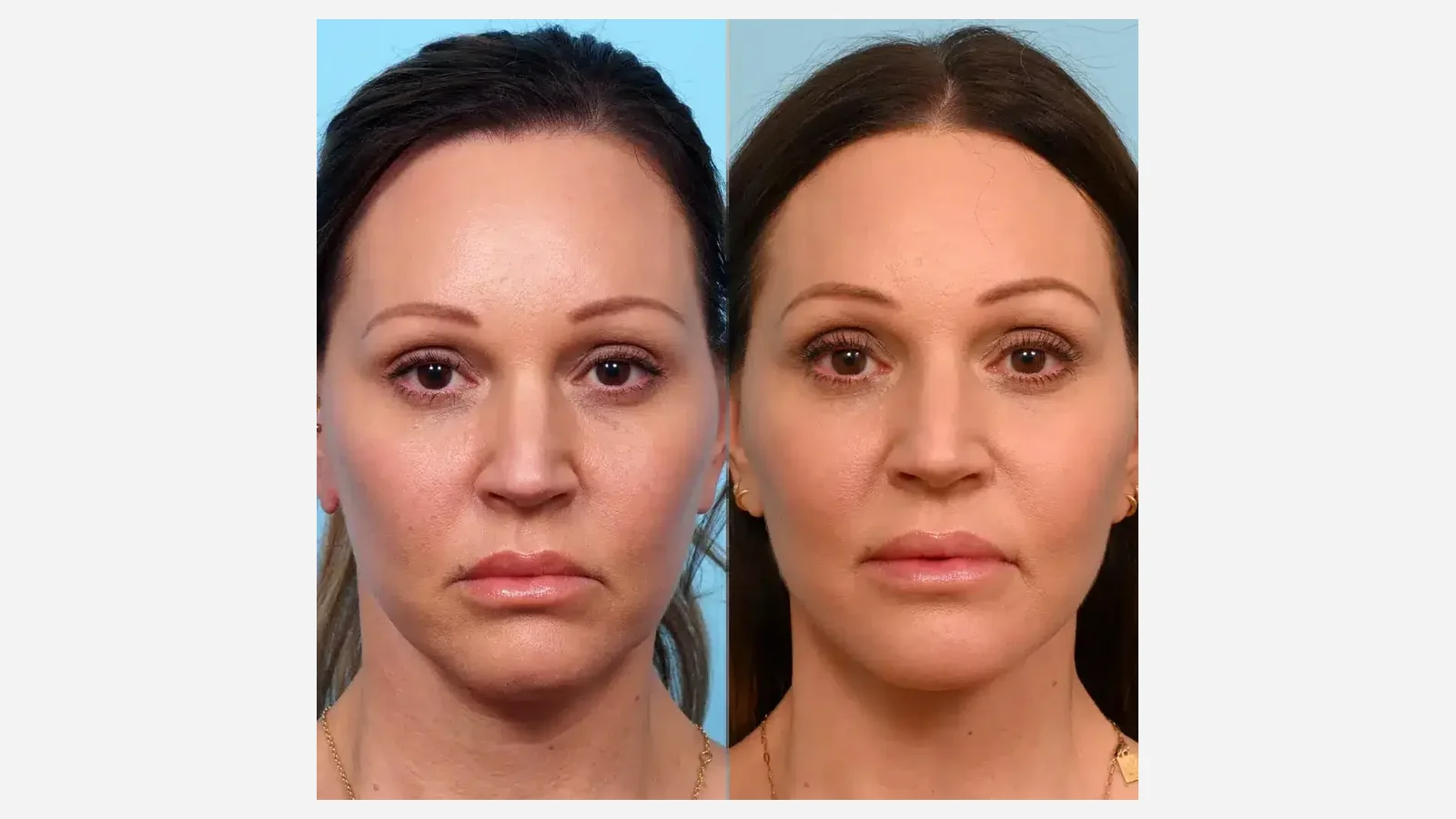 Antes e depois de mini lifting facial em Brasília