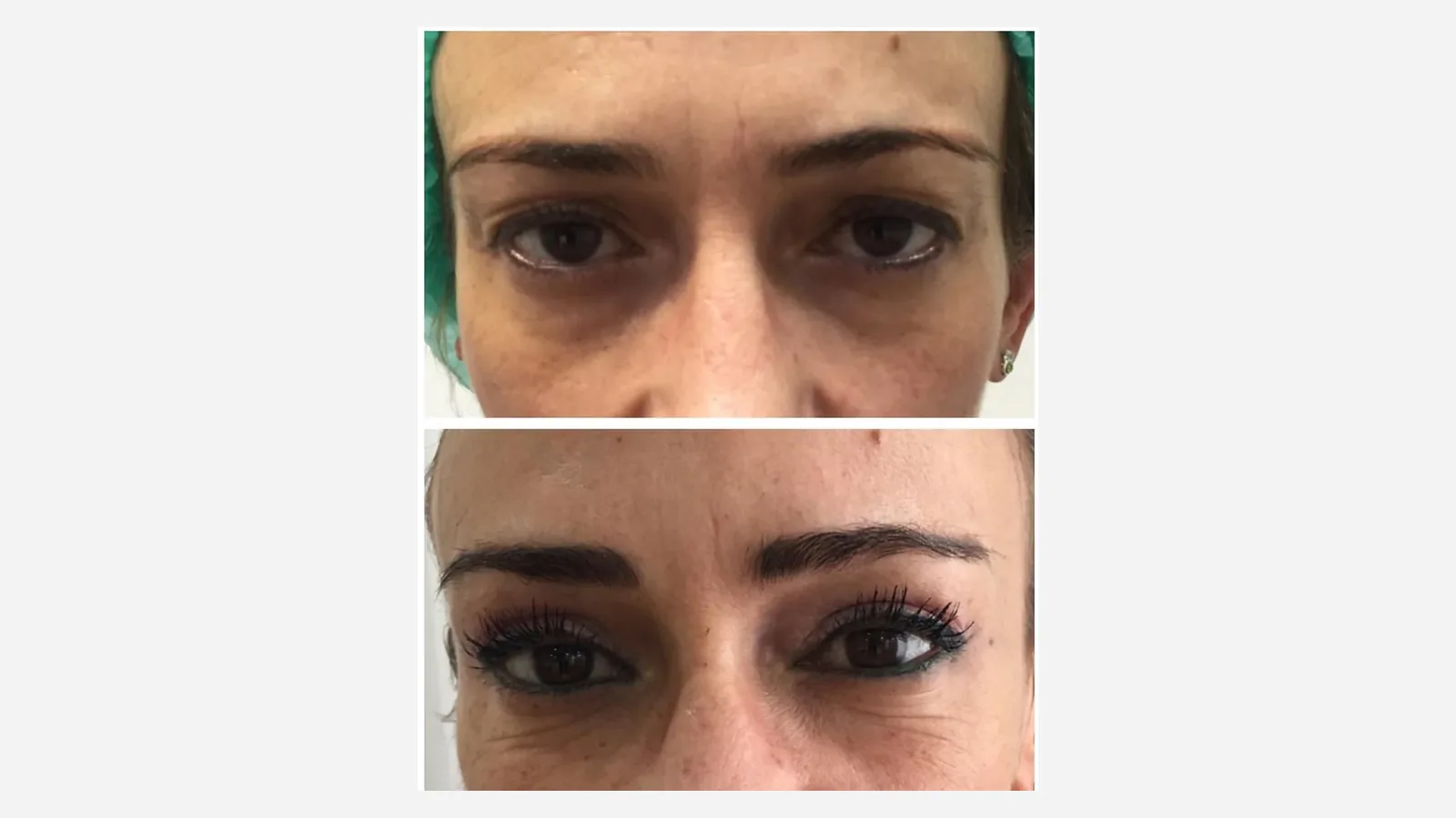 Antes e depois de lifting de sobrancelhas em Brasília