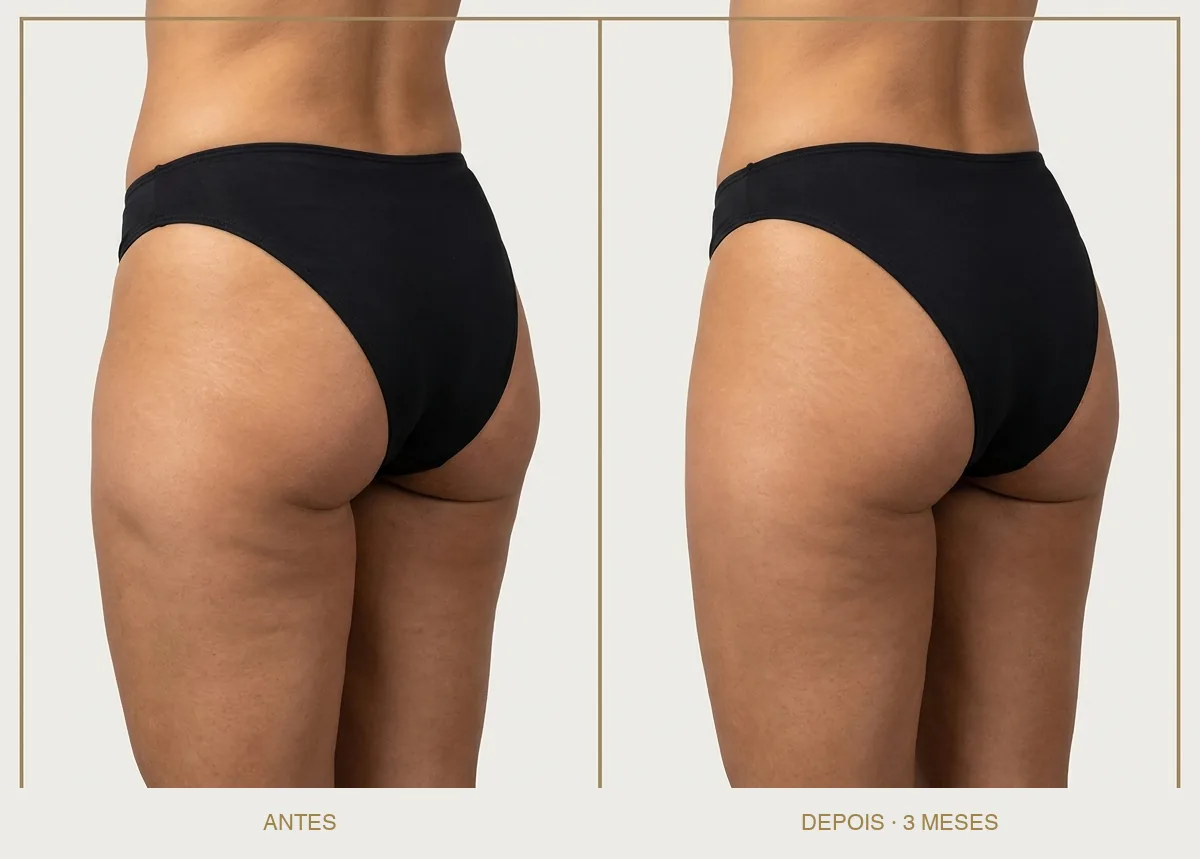 Resultado ilustrativo de Culote — composição editorial antes e depois. Imagem ilustrativa, não corresponde a paciente real.