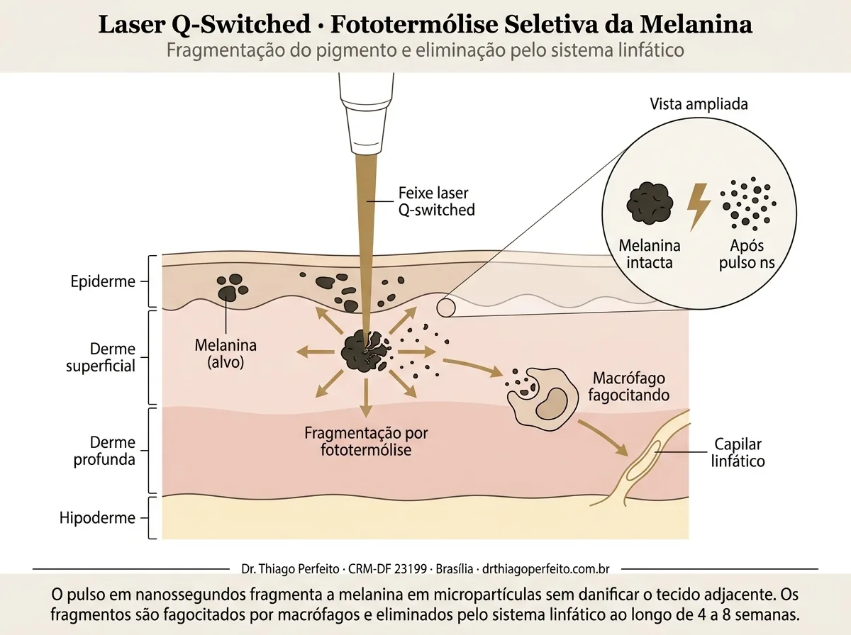 Diagrama anatômico — Laser Q-Plus (despigmentação)