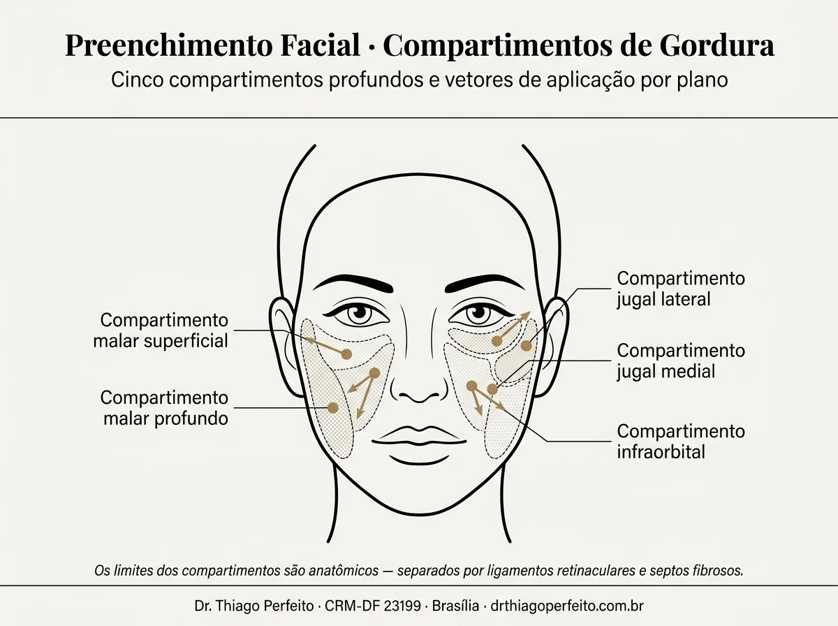 Diagrama dos compartimentos faciais tratados com preenchimento de ácido hialurônico