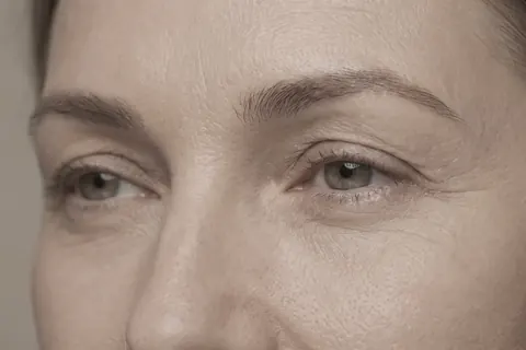 Blefaroplastia sem corte: o que é e como funciona?