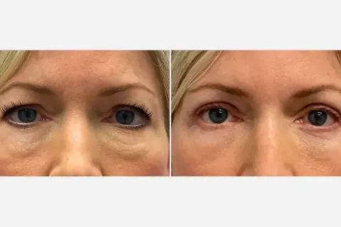 Blefaroplastia vs preenchimento de olheira