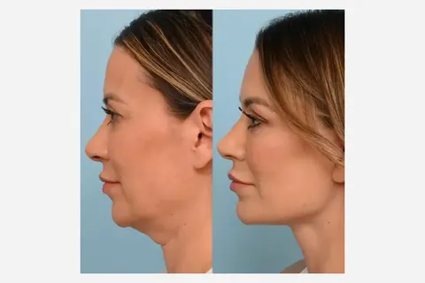 Cirurgia de papada vs lipo de pescoço