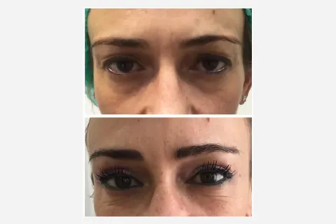 Lifting frontal sem cirurgia: testa e sobrancelha