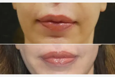 Lip lift: o que é e quando indicar em vez de preenchimento