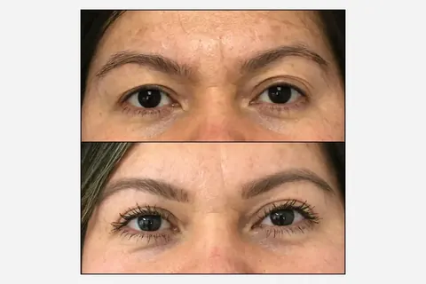 Blefaroplastia: o diagnóstico anatômico e quando a cirurgia é o caminho